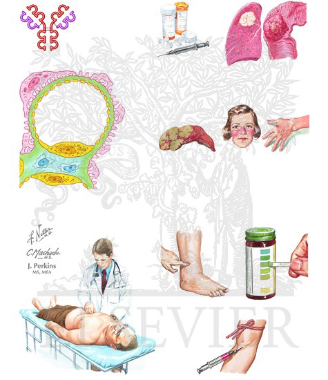 Watermarked preview of unlabeled image: Membranous Nephropathy: Causes and Clinical Features