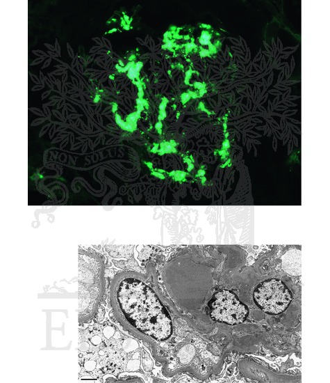 Watermarked preview of unlabeled image: IgA Nephropathy: Histopathologic Findings (Continued)