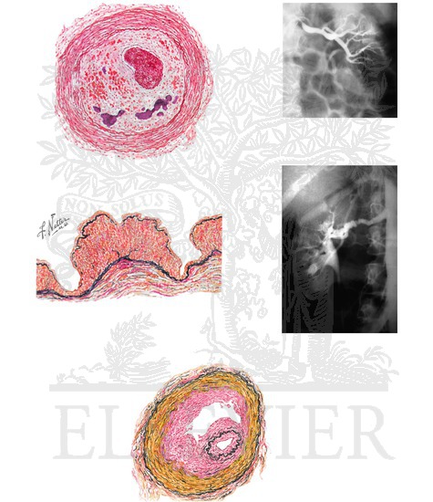 Watermarked preview of unlabeled image: Renal Artery Stenosis: Causes