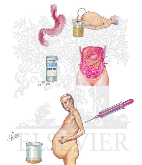 Hepatorenal Syndrome: Symptoms and Diagnosis