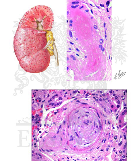 Watermarked preview of unlabeled image: Chronic and Malignant Hypertension: Renal Histopathology (Malignant)