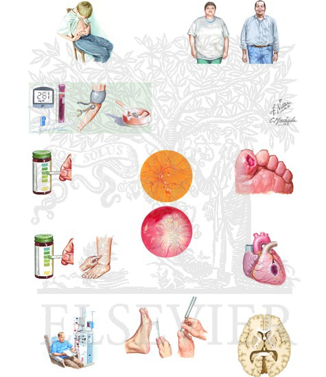 Diabetic Nephropathy: Diabetes Mellitus