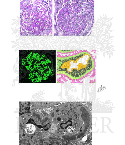Watermarked preview of unlabeled image: Lupus Nephritis: Renal Histopathology (Classes III and IV Lesions)