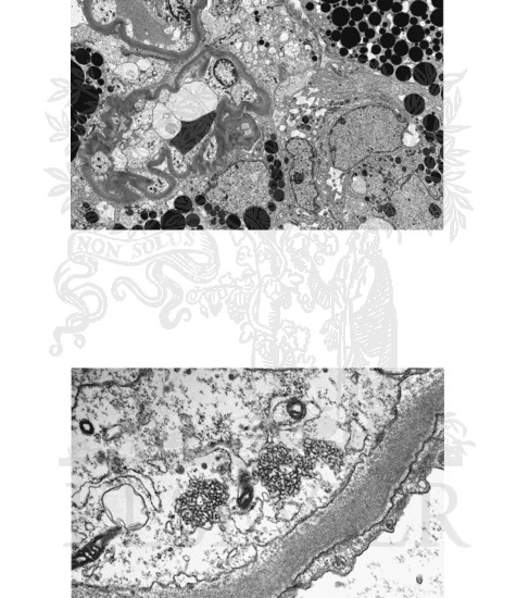 HIV-Associated Nephropathy: Electron Microscopy Findings