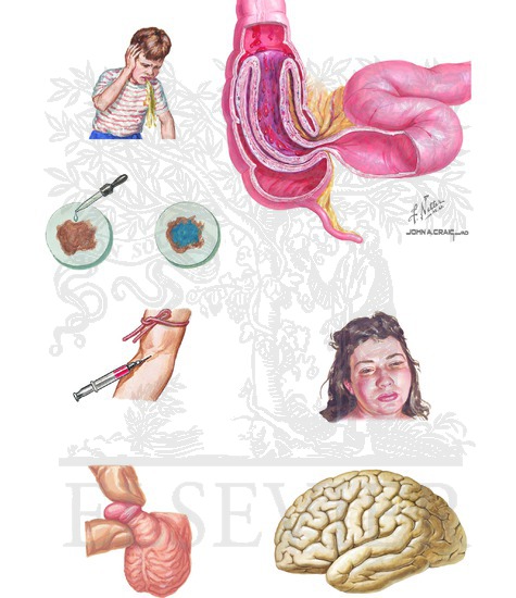 Watermarked preview of unlabeled image: Henoch-Schönlein Purpura: Additional Clinical Features