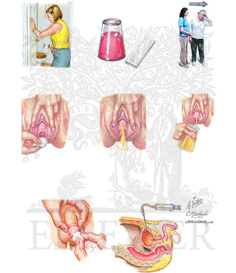 Watermarked preview of unlabeled image: Cystitis: Common Symptoms and Tests