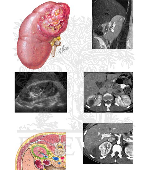 Intrarenal and Perinephric Abscesses