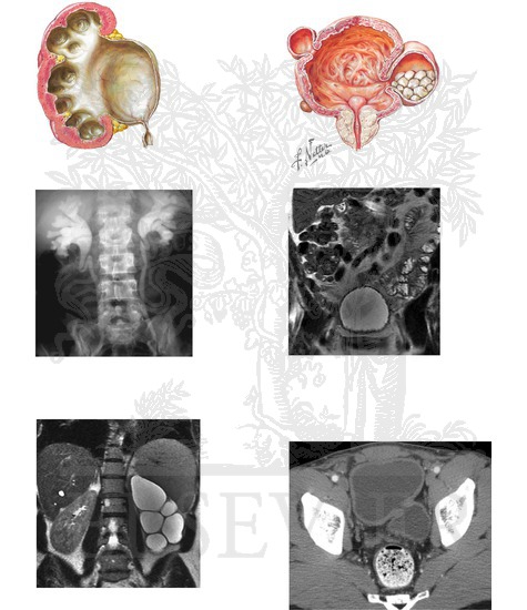 Obstructive Uropathy: Sequelae