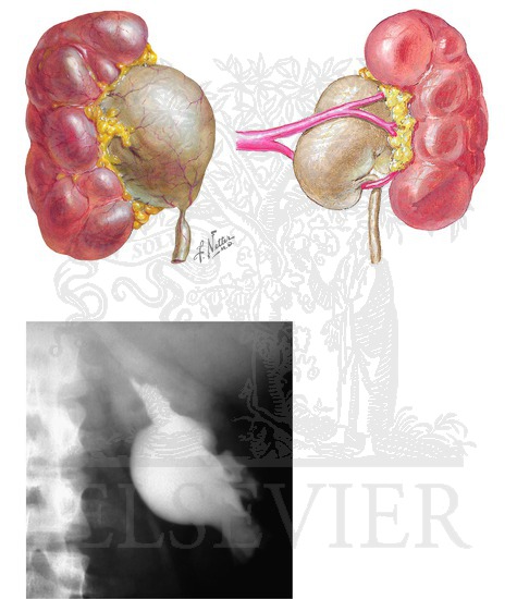 Ureteropelvic Junction Obstruction