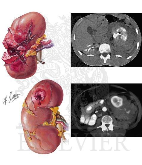 Renal Injuries: Grading System and Renal Parenchymal Injuries
