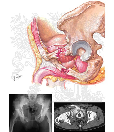 Bladder Injuries: Extraperitoneal Bladder Ruptures