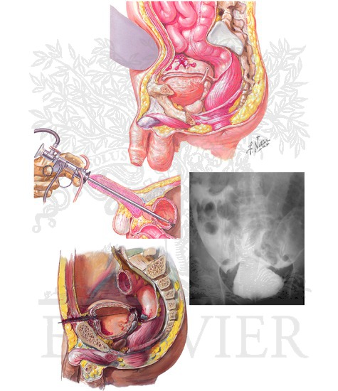 Bladder Injuries: Intraperitoneal Bladder Ruptures