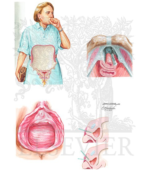 Watermarked preview of unlabeled image: Voiding Dysfunction: Stress Urinary Incontinence