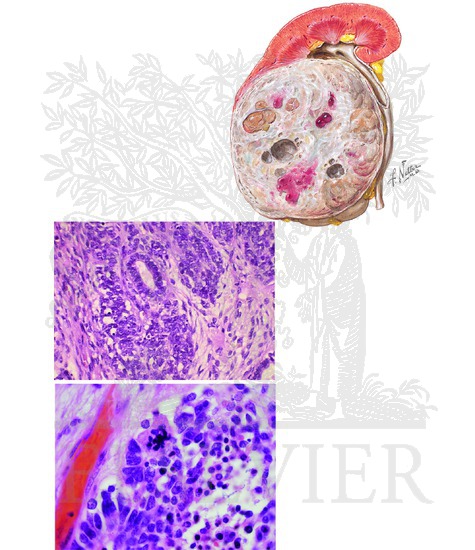 Wilms Tumor: Gross Appearance and Histopathologic Findings