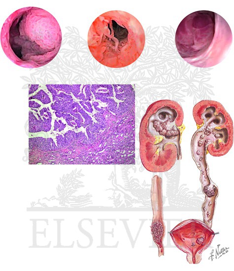 Tumors of the Renal Pelvis and Ureter: Appearance (Ureteroscopic, Gross, and Microscopic) and Staging System