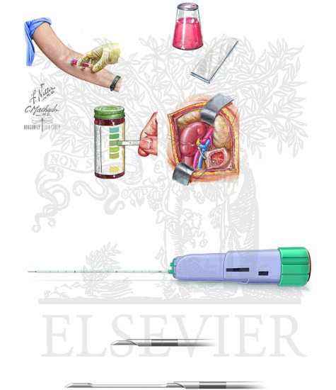 Watermarked preview of unlabeled image: Renal Biopsy: Indications and Structure of Typical Spring-Loaded Needle