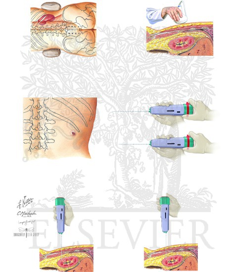Renal Biopsy: Procedure