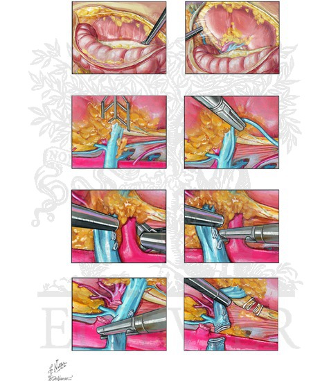 Simple and Radical Nephrectomy: Laparoscopic Radical Nephrectomy (Transperitoneal Approach [Left-Sided])