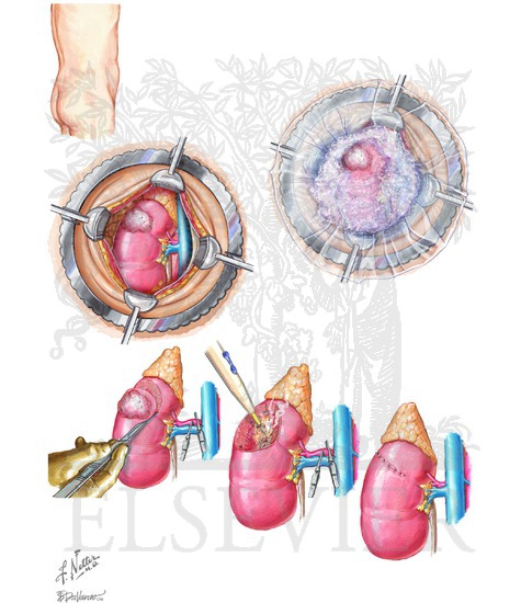 Watermarked preview of unlabeled image: Partial Nephrectomy: Open Partial Nephrectomy (Retroperitoneal [Flank] Approach)