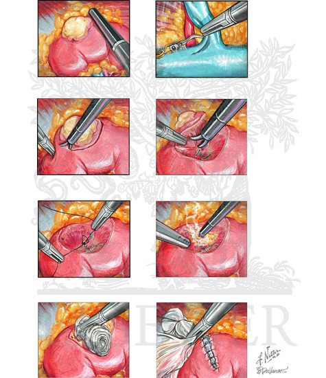 Watermarked preview of unlabeled image: Partial Nephrectomy: Laparoscopic Partial Nephrectomy (Transperitoneal Approach)