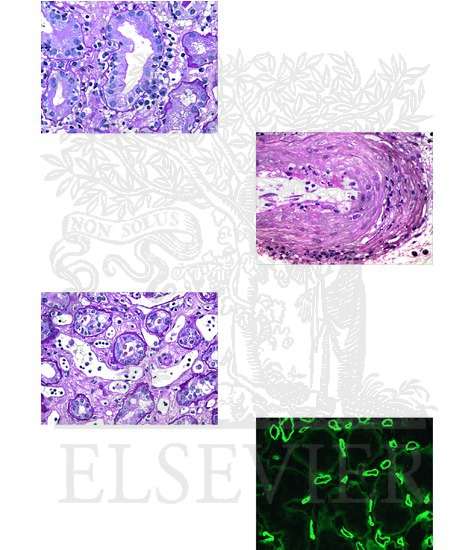 Watermarked preview of unlabeled image: Renal Transplantation: Acute Rejection (Pathologic Findings)