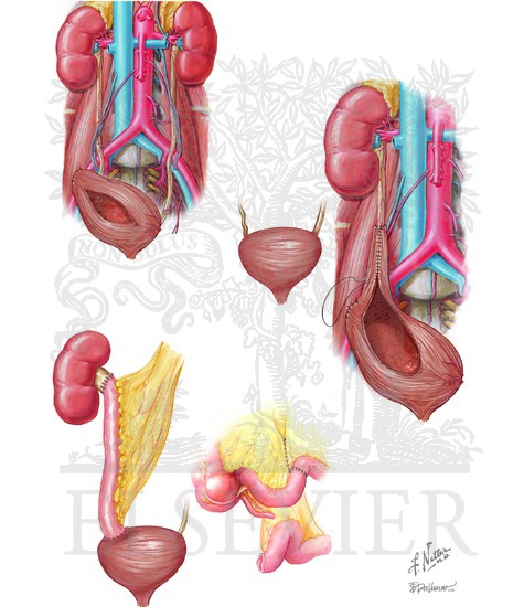 Ureteral Reconstruction