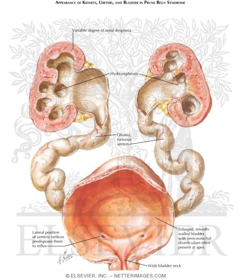 Absent Abdominal Musculature: