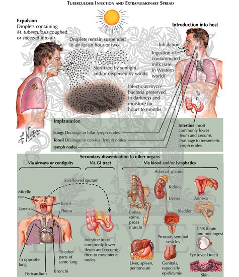Watermarked preview of labeled image: Dissemination of Tuberculosis