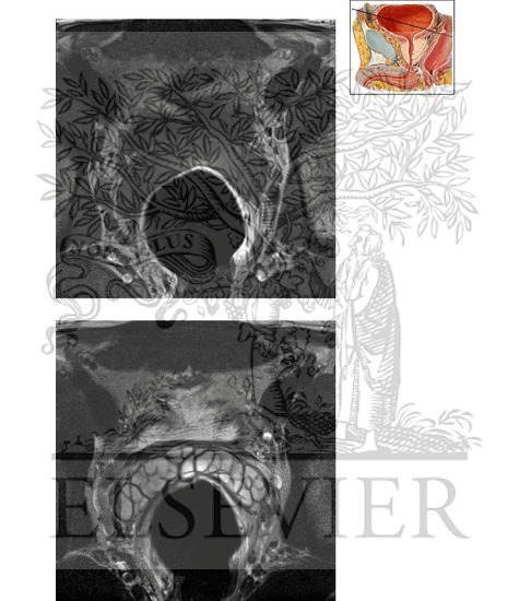 Watermarked preview of unlabeled image: Prostate and Seminal Tract Axial 3