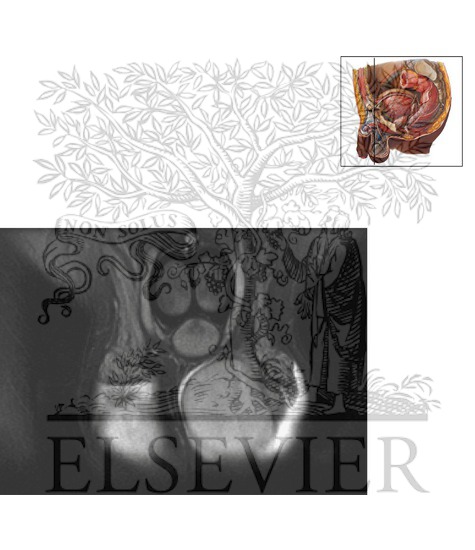 Watermarked preview of unlabeled image: Scrotum and Testes Coronal 2