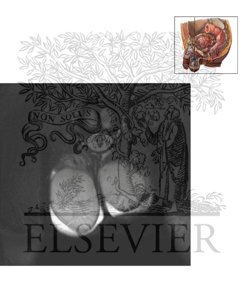 Watermarked preview of unlabeled image: Scrotum and Testes Coronal 4