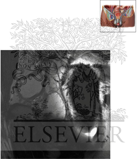 Watermarked preview of unlabeled image: Prostate and Seminal Tract Sagittal 1