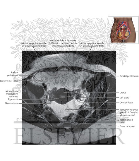 Peritoneal Cavity Pelvis Axial 4 peritoneal-cavity-pelvis-axial-4