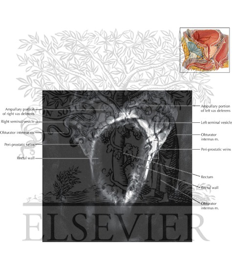 Watermarked preview of labeled image: Prostate and Seminal Tract Coronal 6
