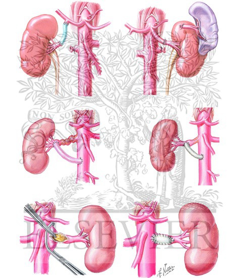 Renal Revascularization: Surgical Therapies