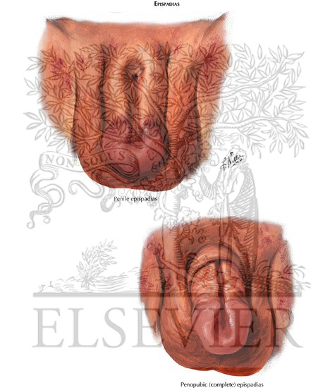 epispadias e hipospadias
