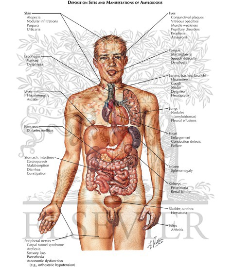 Watermarked preview of labeled image: Amyloid Deposit / Sites and Manifestations