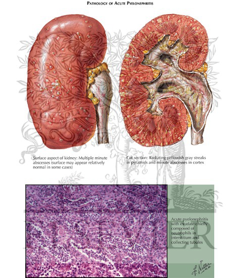 Watermarked preview of labeled image: Acute Pyelonephritis: Pathology