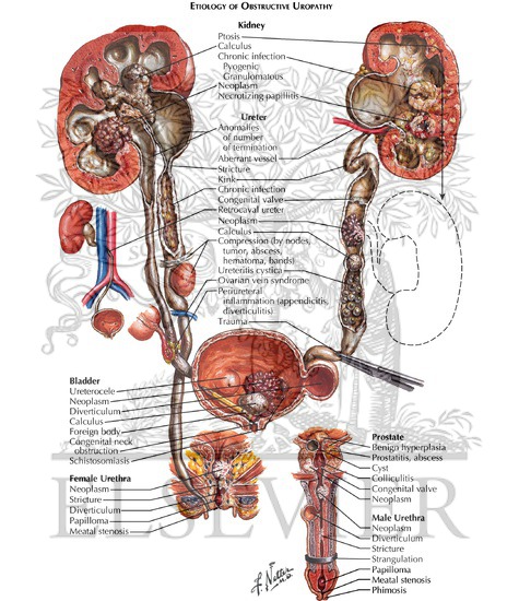 Obstructive Uropathy: Etiology
