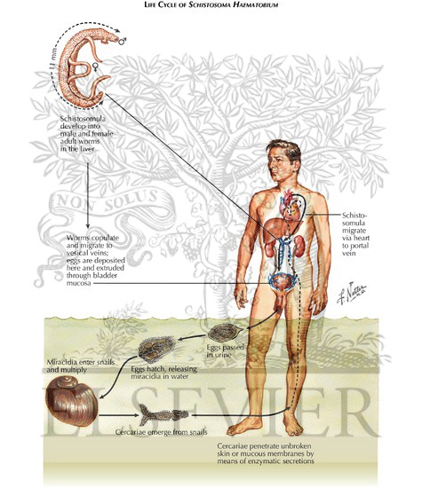 Watermarked preview of labeled image: Urinary Schistosomiasis