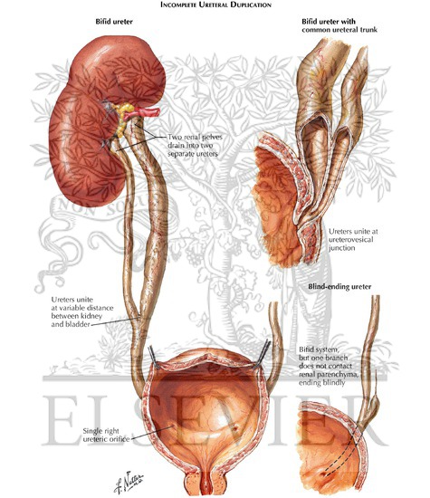 Watermarked preview of labeled image: Incomplete Duplication of Ureter