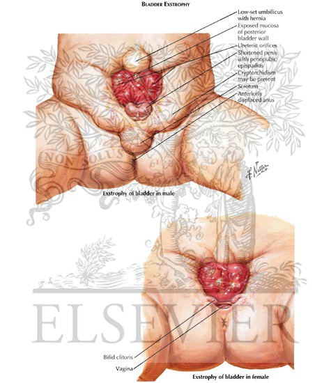 Exstrophy of the Bladder