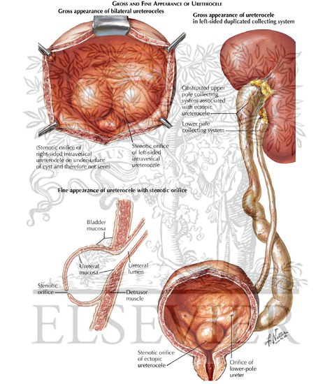 Watermarked preview of labeled image: Ureterocele