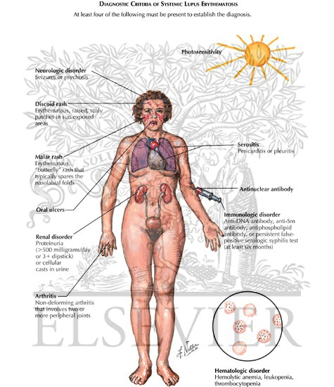 Major Diagnostic Criteria of Systemic Lupus Erythematosus (SLE)