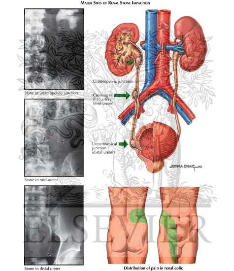 Watermarked preview of labeled image: Calculous Urinary Obstruction