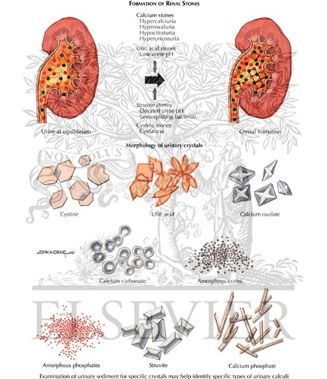 formation of urinary calculi urinary stones
