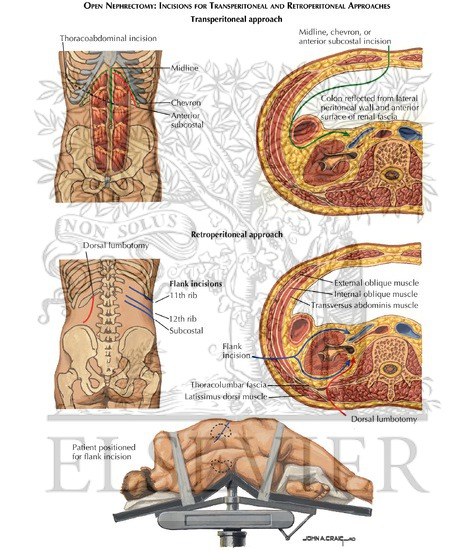 term papers radical neprectomy term papers radical neprectomy