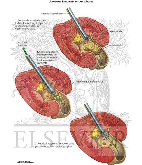 Urinary Calculi: Percutaneous Ultrasonic Lithotripsy