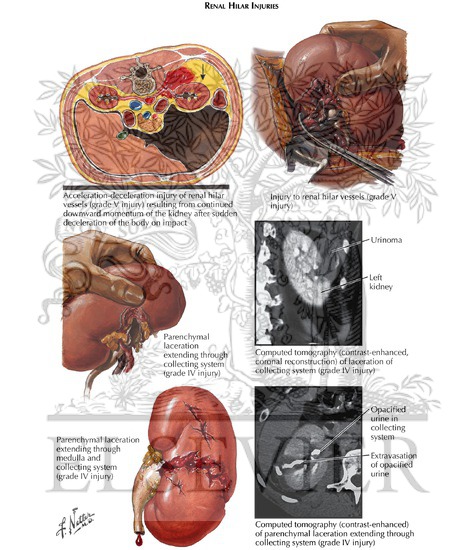 Watermarked preview of labeled image: Bladder Injuries: Intraperitoneal Bladder Ruptures