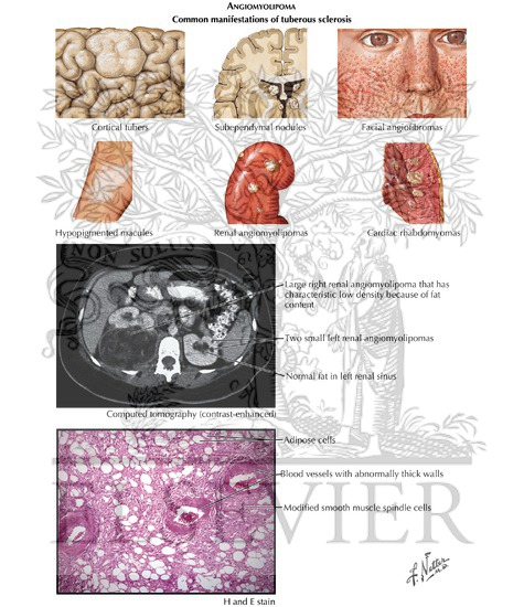Watermarked preview of labeled image: Implant Resection Arthroplasty for Proximal Interphalangeal Joint
